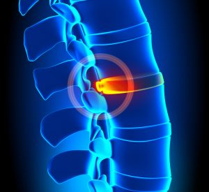 Have a Herniated Disc? A Chiropractor Can Help - Macomb Township  Chiropractic